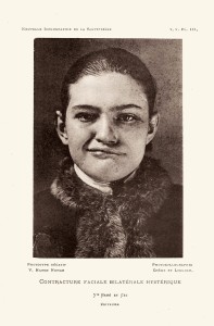 Contracture faciale bilatérale hystérique 1891
© Nouvelle iconographie de la Salpêtrière, Paris